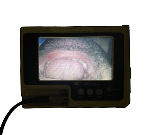 VERATHON Glidescope Portable GVL Video Laryngoscope Monitor W 1/2 & 4/4 Camera button