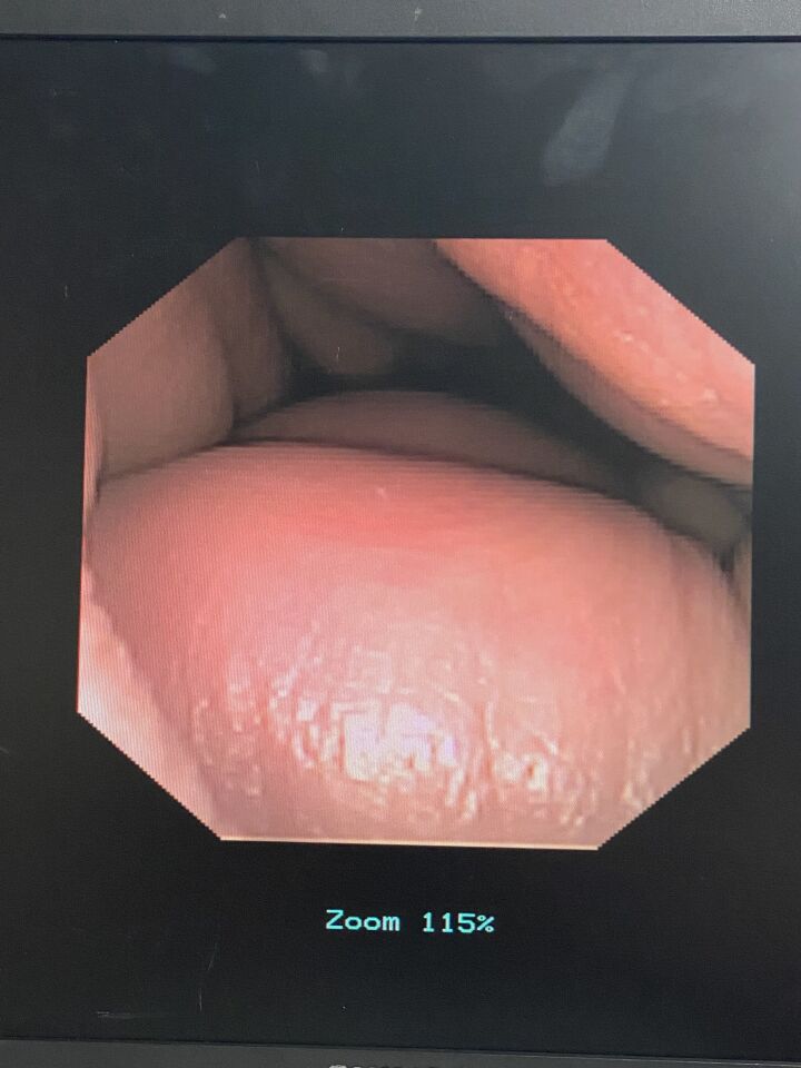 GYRUS ACMI DUR-D URETEROSCOPE W/ INVISIO IDC-1500 CONSOLE Ureteroscope