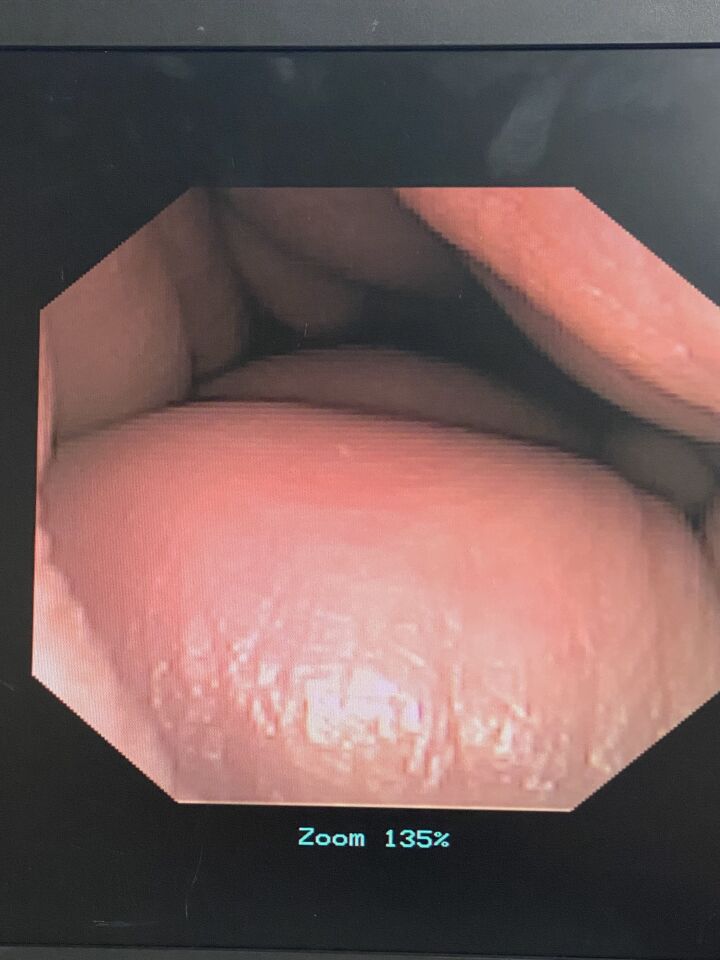 GYRUS ACMI DUR-D URETEROSCOPE W/ INVISIO IDC-1500 CONSOLE Ureteroscope