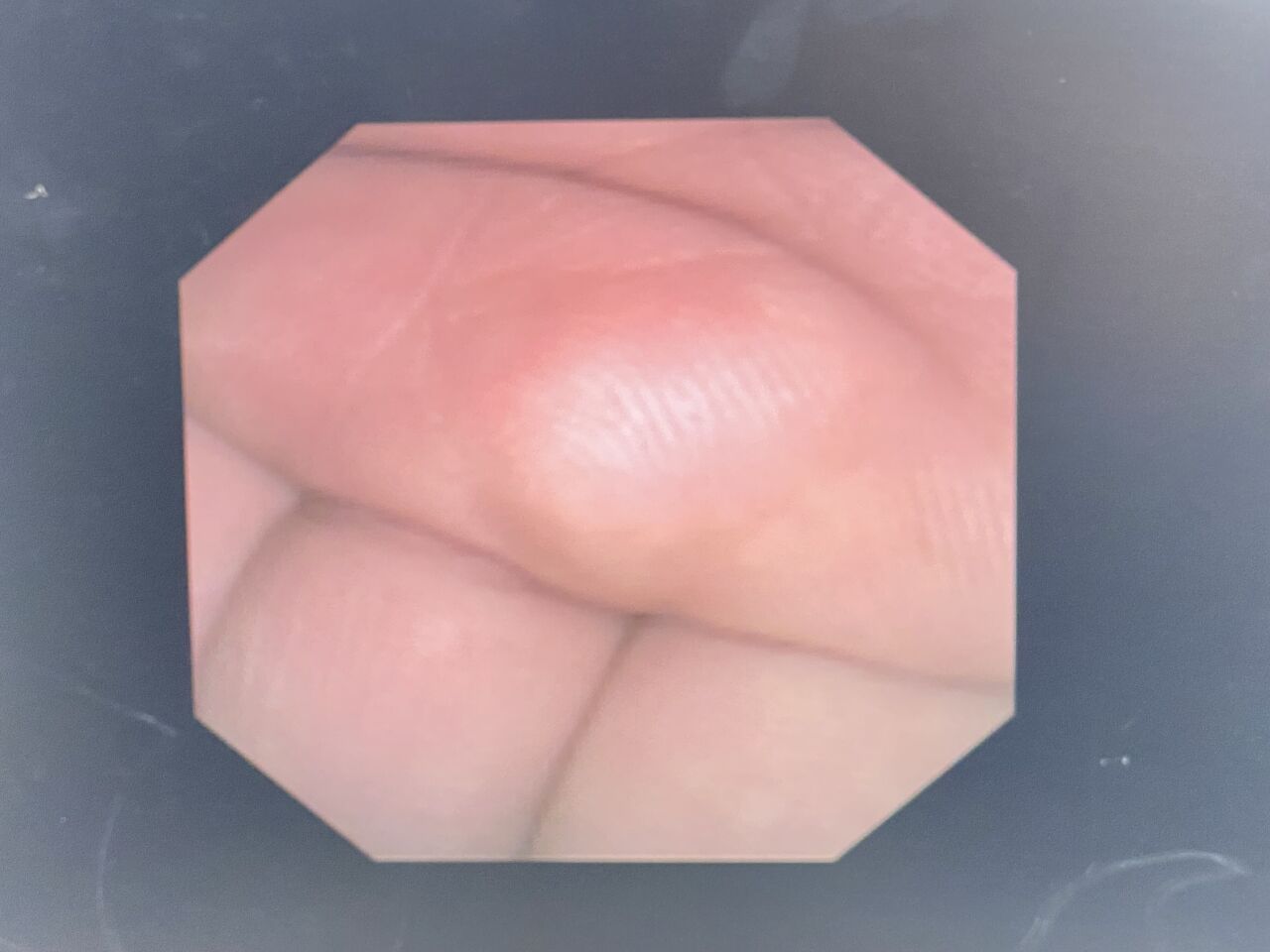 GYRUS ACMI DUR-D URETEROSCOPE W/ INVISIO IDC-1500 CONSOLE Ureteroscope