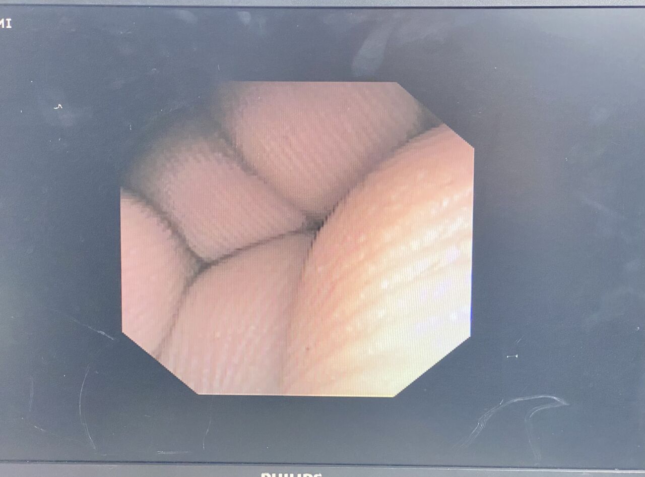 GYRUS ACMI DUR-D URETEROSCOPE W/ INVISIO IDC-1500 CONSOLE Ureteroscope