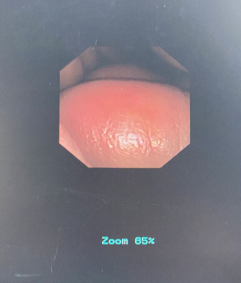 GYRUS ACMI DUR-D URETEROSCOPE W/ INVISIO IDC-1500 CONSOLE Ureteroscope